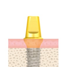 UF(II) Cemented Abutment  Submerged