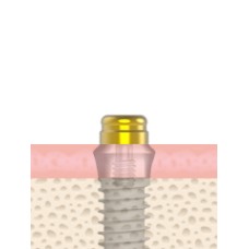 UF(II) Kerator Abutment Non-Submerged