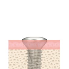 UF(II) Narrow Healing Abutment Submerged